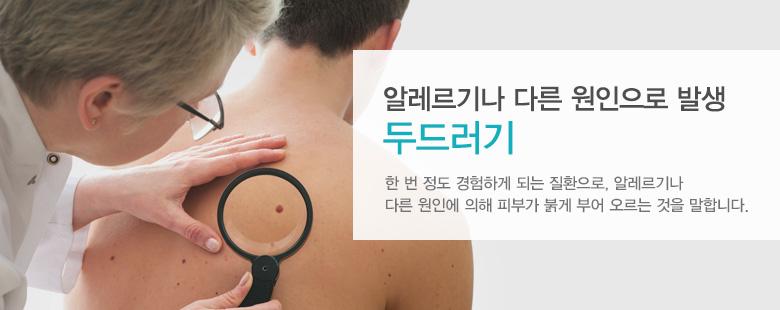 알레르기나 다른 원인으로 발생 두드러기