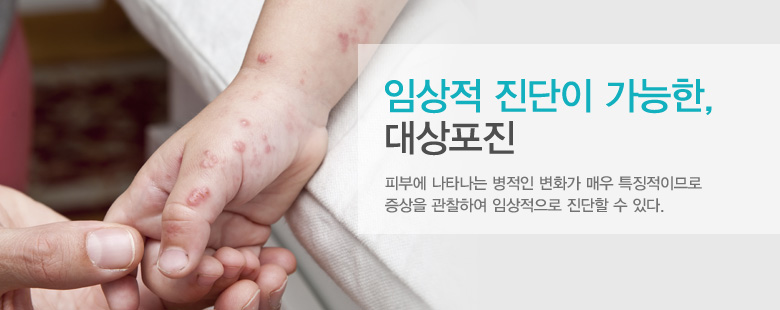 임상적 진단이 가능한,대상포진