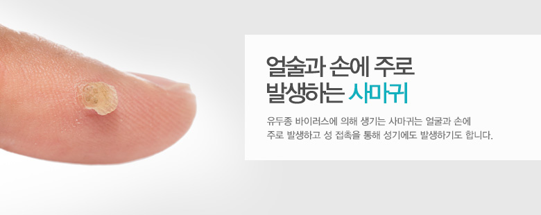 얼술과 손에 주로 발생하는 사마귀