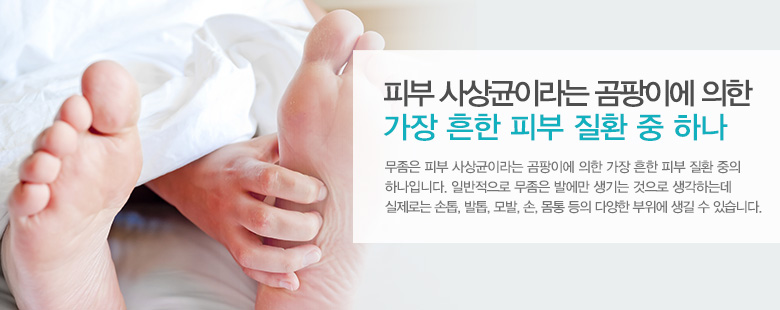 피부 사상균이라는 곰팡이에 의한 가장 흔한 피부 질환 중 하나