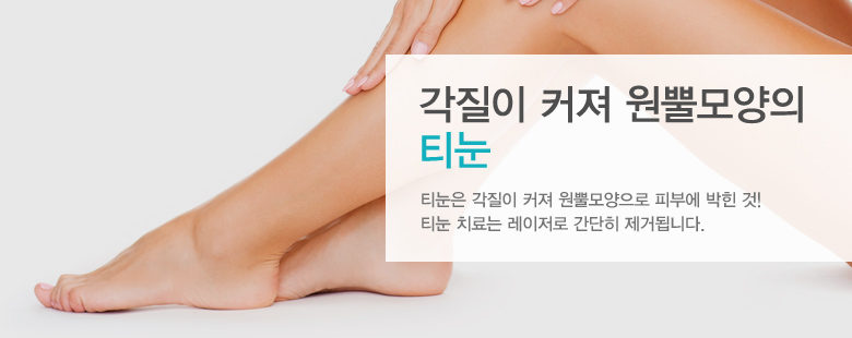 각질이 커져 원뿔모양의 티눈